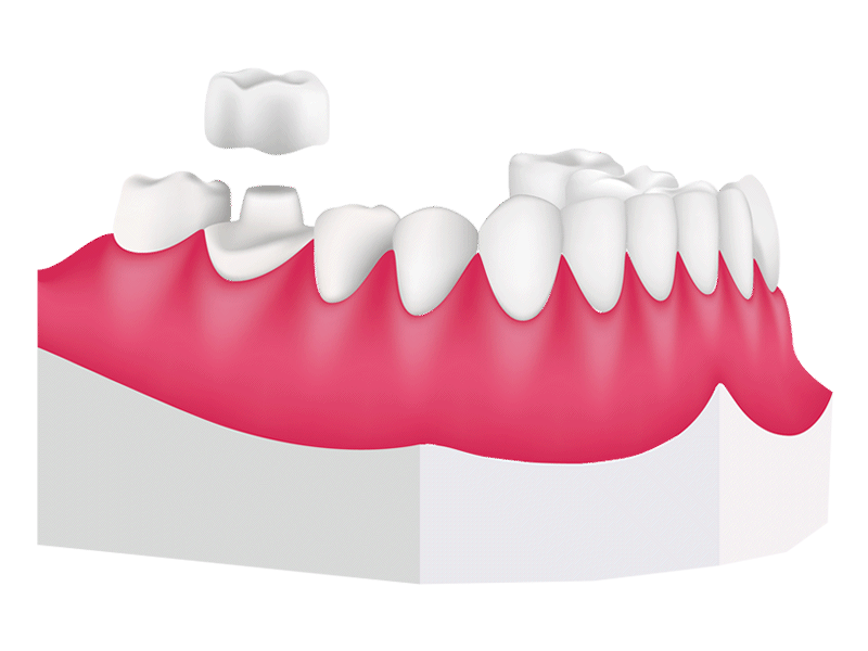 Children's Dental Crowns