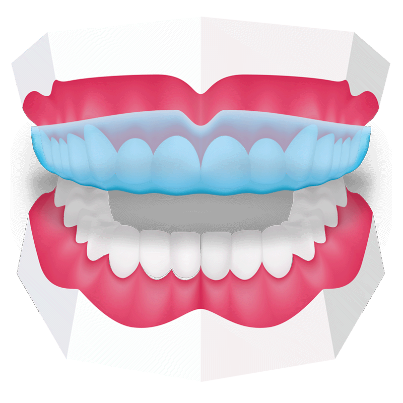 Children's mouthguards