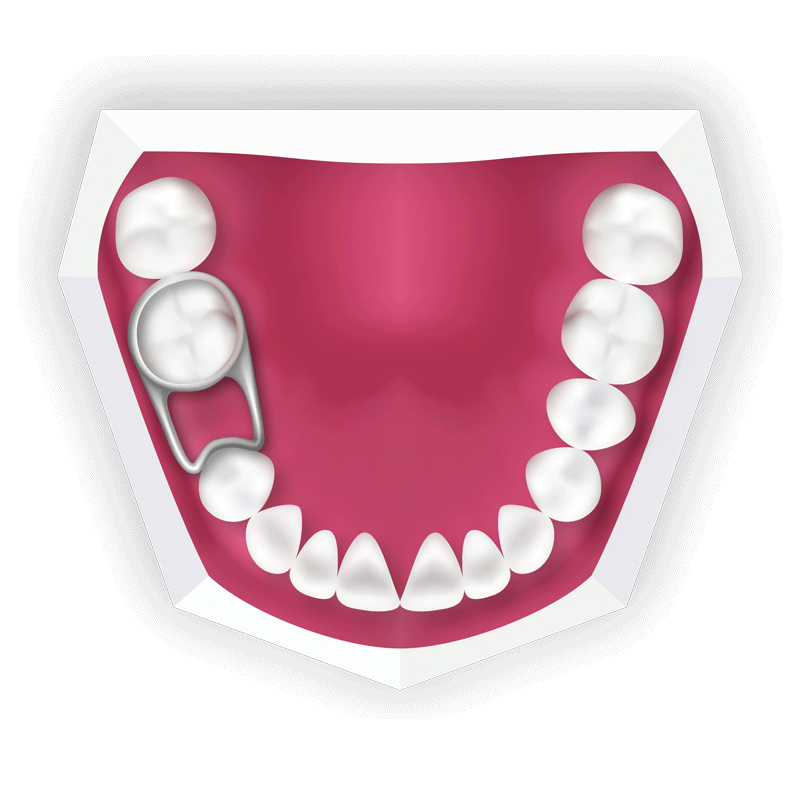 Space Maintainers for Kids 5* Children's Dental Expert London